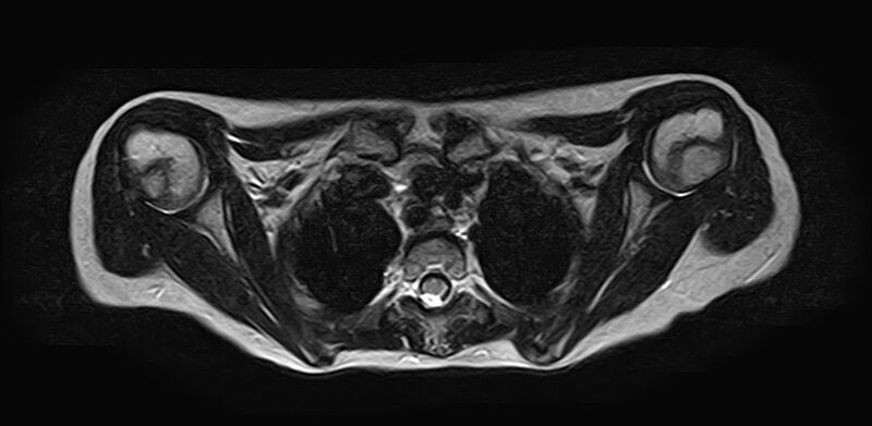 File:Bilateral Sprengel deformity with Klippel-Feil syndrome (Radiopaedia 66395-75650 Axial T2 23).jpg