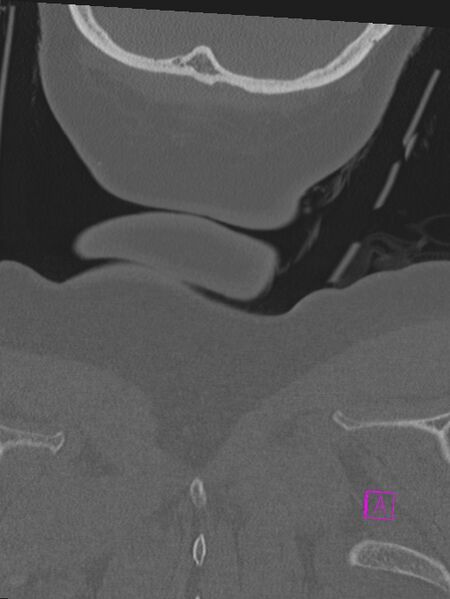 File:Bilateral atlanto-occipital assimilation (Radiopaedia 28350-28603 Coronal bone window 58).jpg