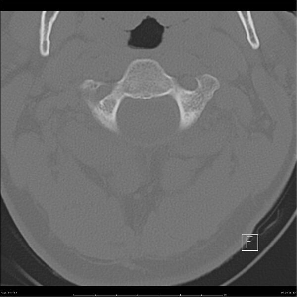 File:Bilateral cervical ribs (Radiopaedia 25868-26017 Axial bone window 14).jpg