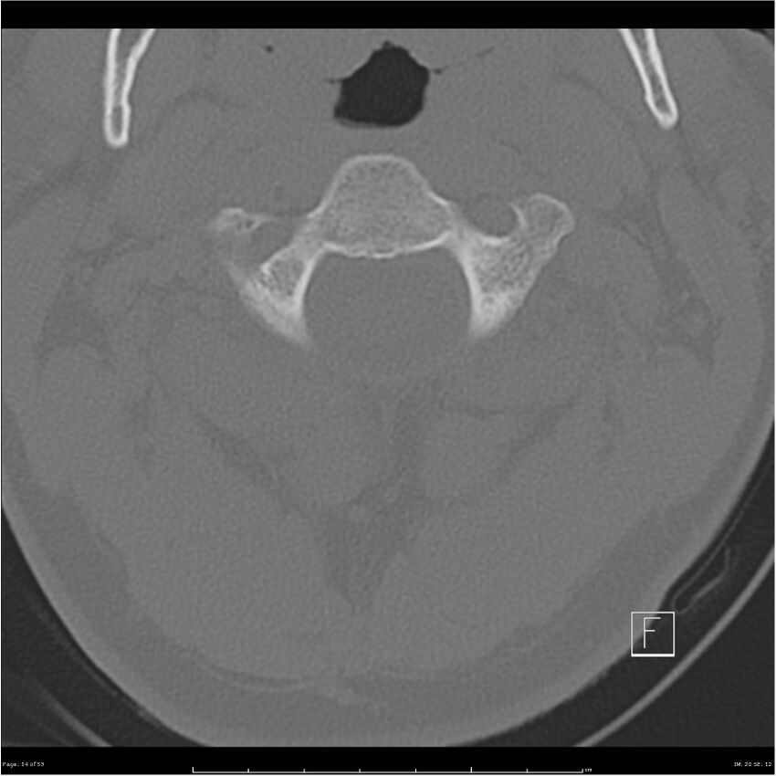 Bilateral cervical ribs (Radiopaedia 25868-26017 Axial bone window 14).jpg