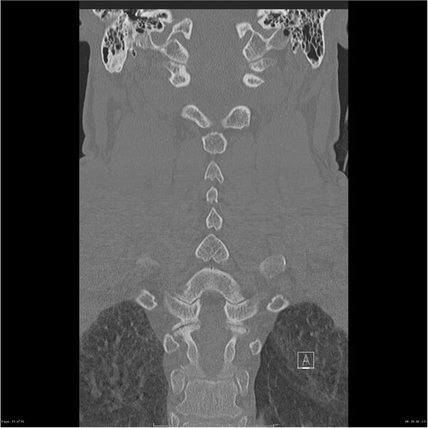 File:Bilateral cervical ribs (Radiopaedia 25868-26017 Coronal bone window 31).jpg
