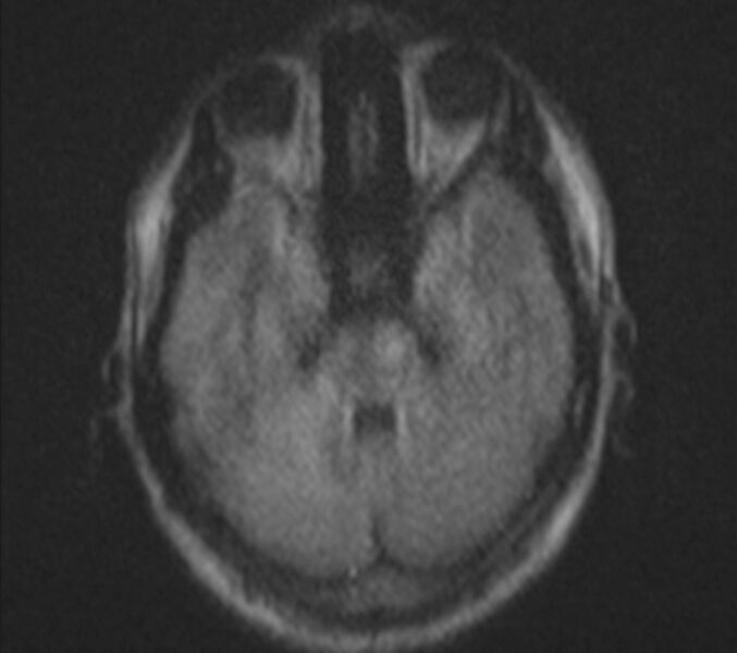 File:Bilateral cholesteatoma (Radiopaedia 54898-61173 Axial DWI 9).jpg