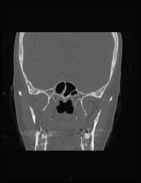 File:Bilateral frontal mucoceles (Radiopaedia 82352-96454 Coronal 228).jpg