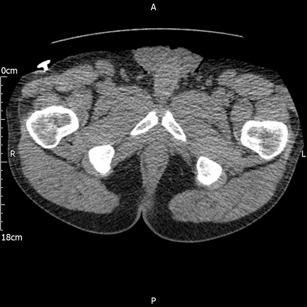 File:Bilateral medullary nephrocalcinosis with ureteric calculi (Radiopaedia 71269-81569 Axial non-contrast 143).jpg