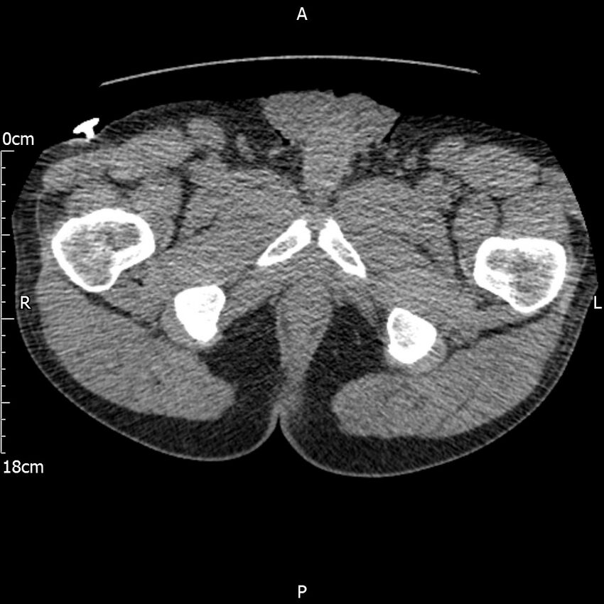 Bilateral medullary nephrocalcinosis with ureteric calculi (Radiopaedia 71269-81569 Axial non-contrast 143).jpg