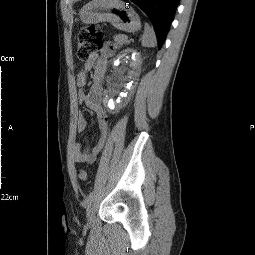 Bilateral medullary nephrocalcinosis with ureteric calculi (Radiopaedia 71269-81569 C 39).jpg