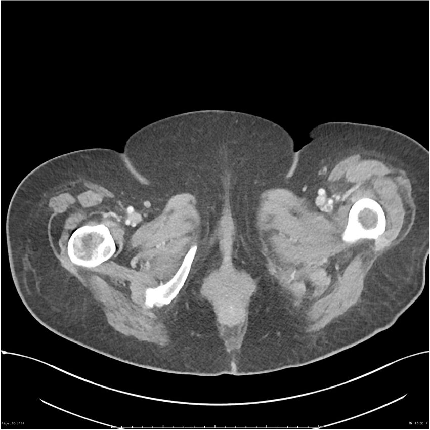 Bilateral psoas hematomas (Radiopaedia 24057-24279 A 95).jpg
