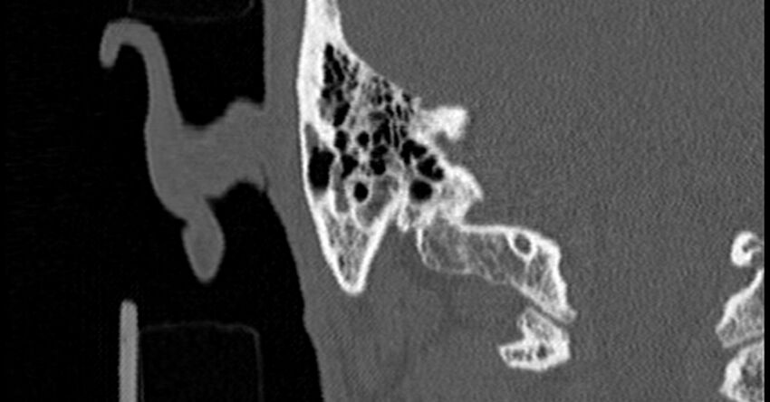 Bilateral temporal bone fractures (Radiopaedia 29482-29970 Coronal non-contrast 154).jpg
