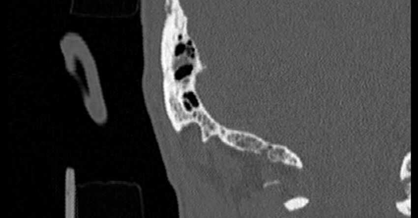 Bilateral temporal bone fractures (Radiopaedia 29482-29970 Coronal non-contrast 177).jpg