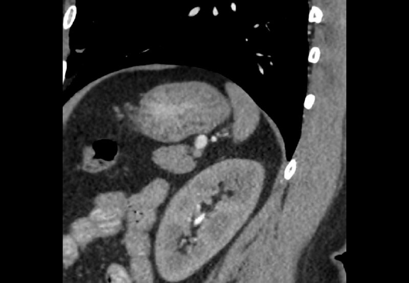 File:Bilateral urolithiasis with incidentally detected splenic artery aneurysm and left inferior vena cava (Radiopaedia 44467-48127 Ob. Sag. C+ Art. 9).jpg