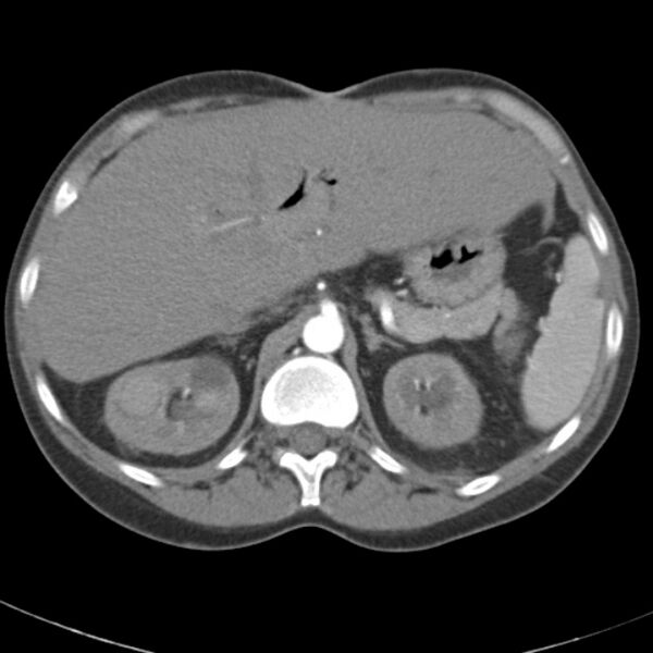 File:Biliary necrosis - liver transplant (Radiopaedia 21876-21845 A 17).jpg