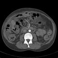 Biliary necrosis - liver transplant (Radiopaedia 21876-21846 A 37).jpg