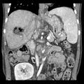 Biliary necrosis - liver transplant (Radiopaedia 21876-21846 C 26).jpg