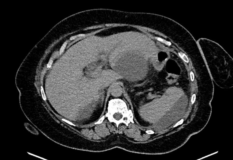 File:Biliary pancreatitis (Radiopaedia 72289-82823 Axial non-contrast 78).jpg