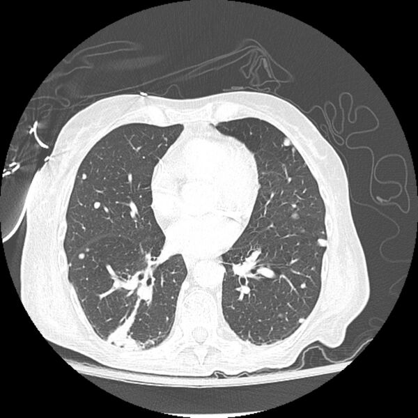 File:Bladder cancer metastases (Radiopaedia 9824-10409 Axial lung window 1).jpg