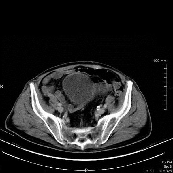 File:Bladder squamous cell carcinoma (Radiopaedia 14130-13984 B 3).jpg