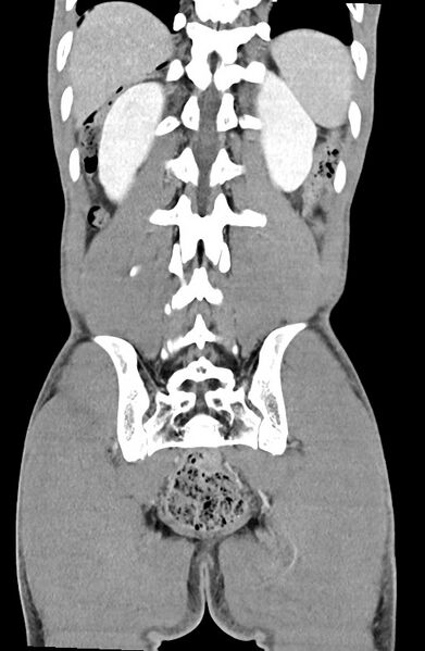 File:Blunt injury to the small bowel (Radiopaedia 74953-85987 B 77).jpg