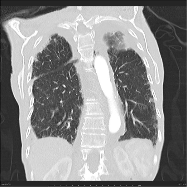 File:Boerhaave syndrome (Radiopaedia 26240-26362 Coronal lung window 25).jpg