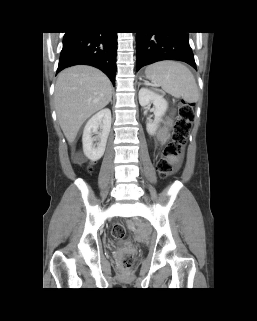 Bowel lymphoma complicated by bleeding after therapy (Radiopaedia 55601-62107 B 45).jpg