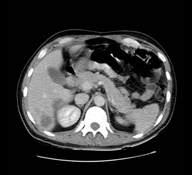 File:Bowel obstruction from colon carcinoma (Radiopaedia 22995-23028 A 22).jpg