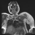 Brachial plexopathy (Radiopaedia 21844-21806 Coronal T1 C+ 3).jpg