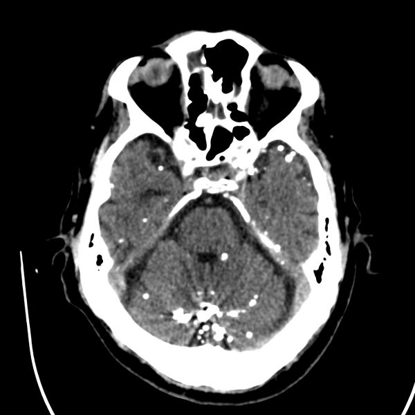 File:Brain Pantopaque remnants (Radiopaedia 78403-91048 Axial non-contrast 36).jpg