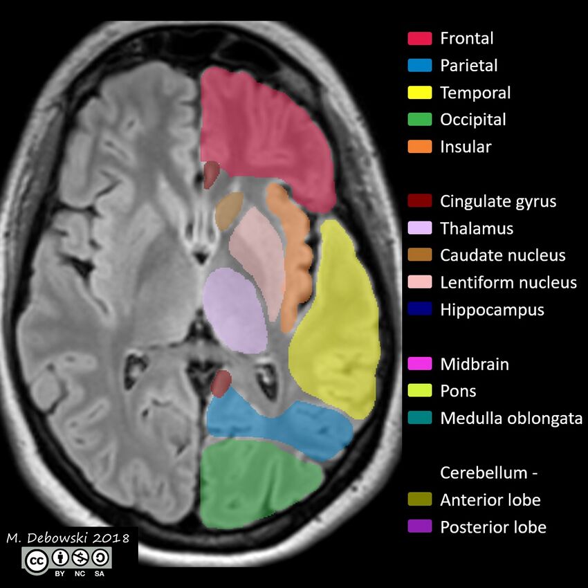 Brain lobes - annotated MRI (Radiopaedia 61691-69700 Axial 38).JPG