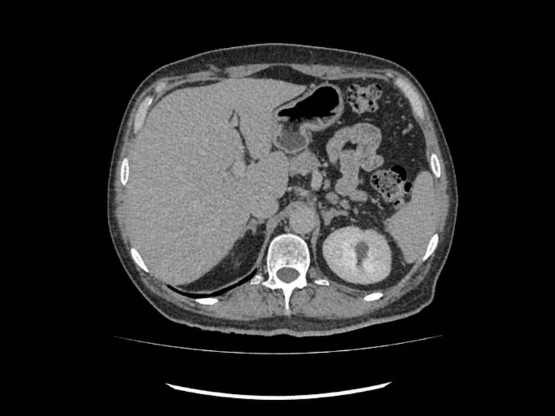 File:Brain metastases from renal cell carcinoma (Radiopaedia 42222-45328 Axial C+ delayed 25).jpg