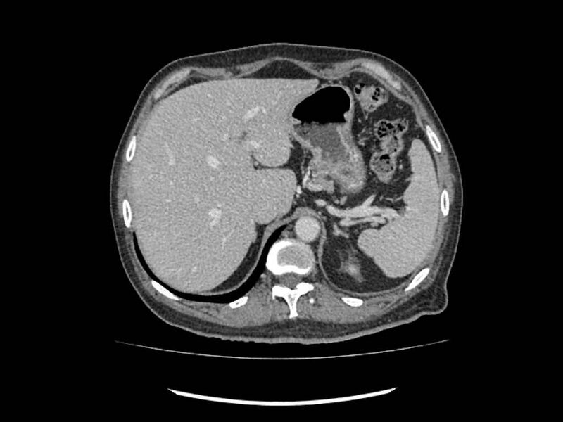 File:Brain metastases from renal cell carcinoma (Radiopaedia 42222-45328 B 2).jpg