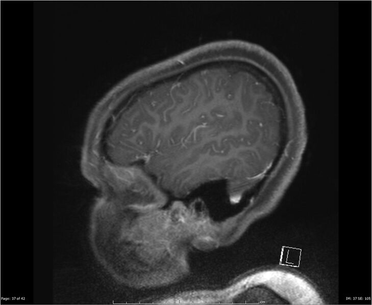 File:Brainstem glioma (Radiopaedia 21819-21775 D 37).jpg