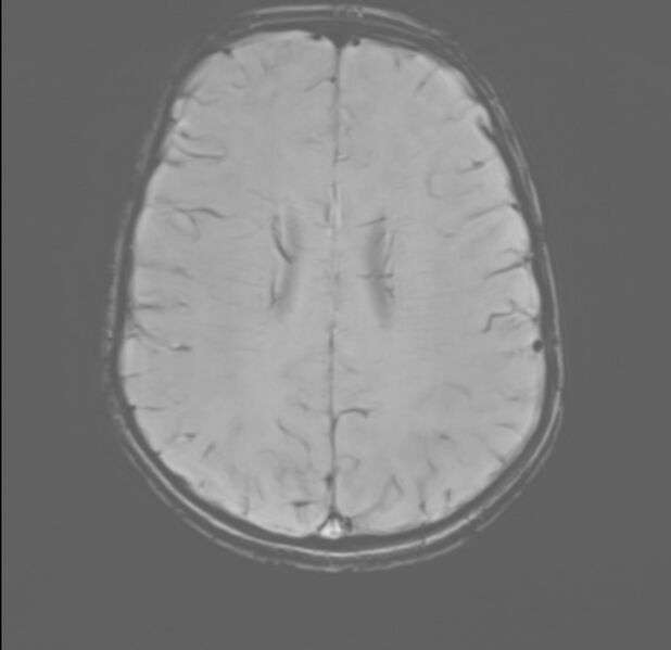 File:Brainstem glioma (Radiopaedia 70548-80674 Axial SWI 42).jpg