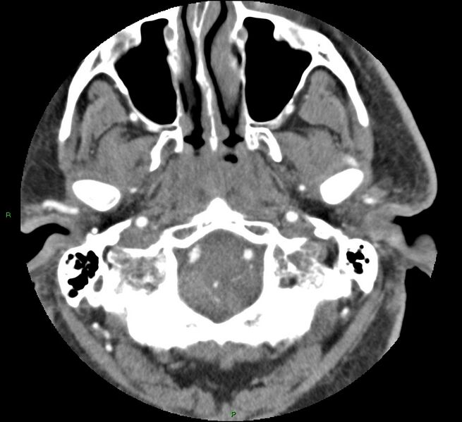 File:Brainstem hemorrhage (Radiopaedia 58794-66028 D 25).jpg