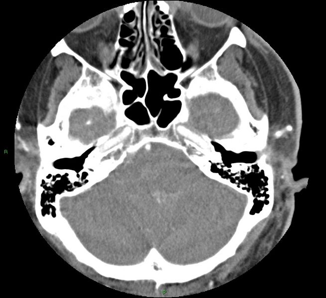 File:Brainstem hemorrhage (Radiopaedia 58794-66028 D 43).jpg