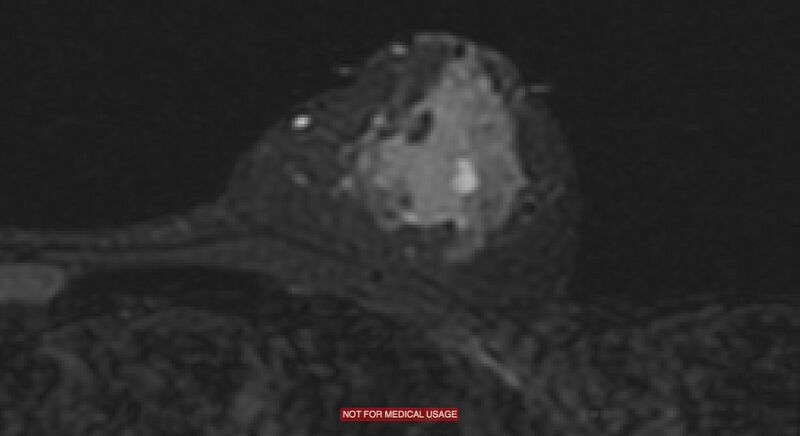 File:Breast lymphoma (MRI) (Radiopaedia 34999-36498 Axial STIR 3).jpg