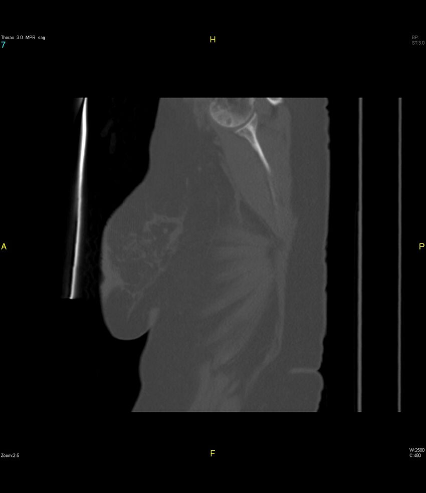 Breast primary with lung and bone metastases (Radiopaedia 40620-43228 Sagittal bone window 7).jpg