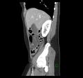 Broad ligament hernia (Radiopaedia 63260-71832 C 15).jpg