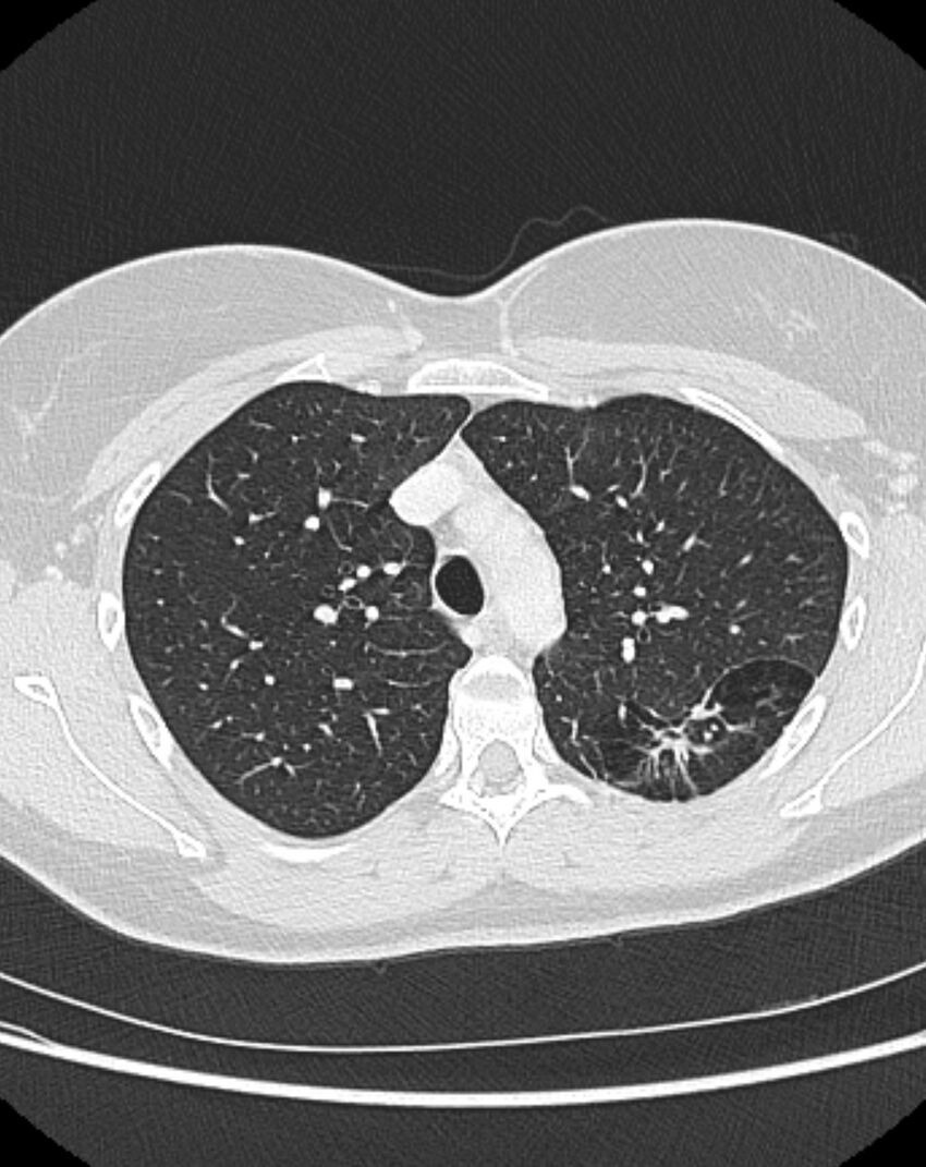 Bronchial atresia (Radiopaedia 50007-55297 Axial lung window 28).jpg
