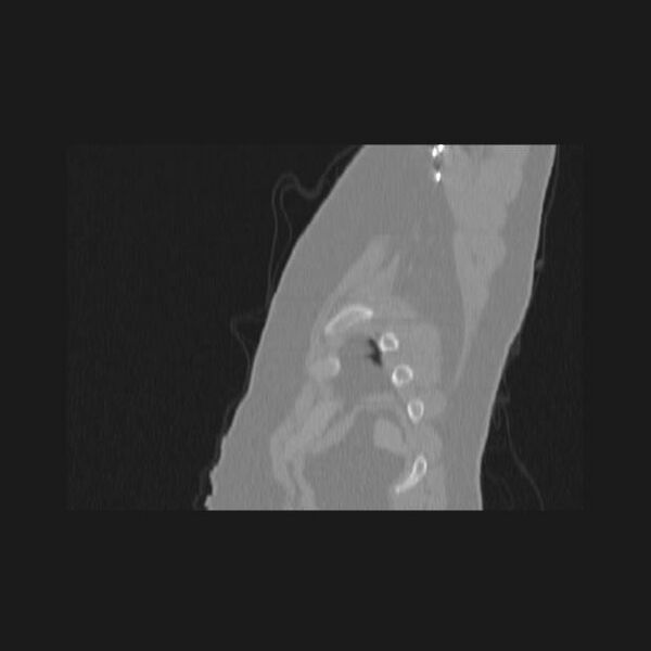 File:Bronchial atresia (Radiopaedia 60685-68439 Sagittal lung window 96).jpg