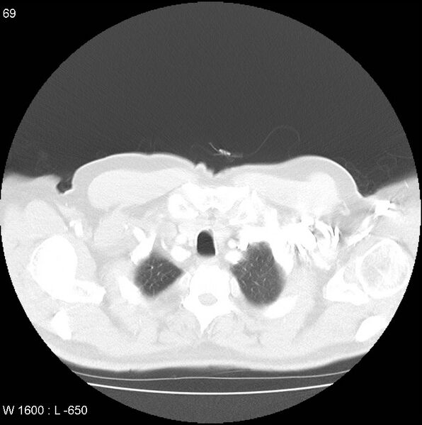 File:Bronchial carcinoid tumor with right lower lobe collapse (Radiopaedia 29060-29422 B 7).jpg