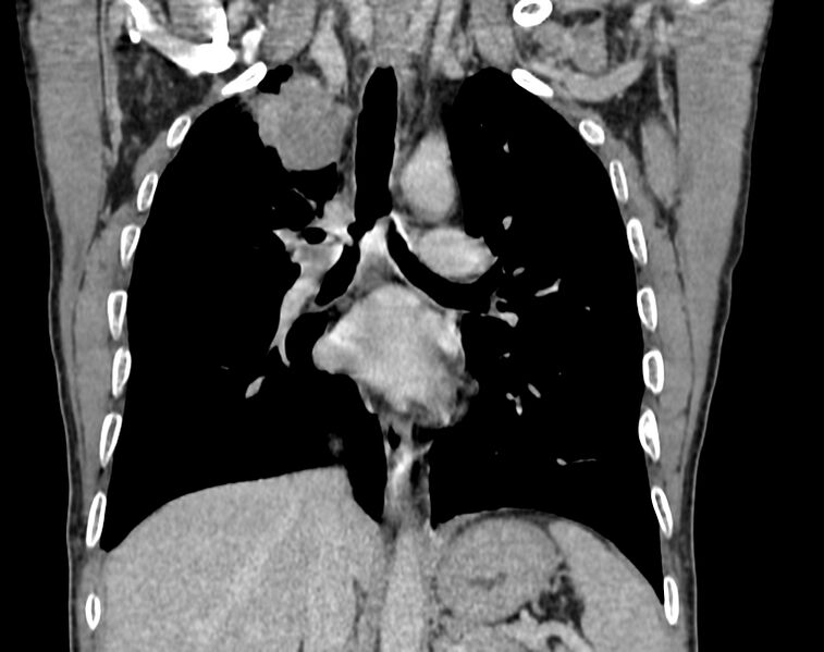 File:Bronchogenic carcinoma with superior vena cava syndrome (Radiopaedia 36497-38054 Coronal C+ delayed 50).jpg