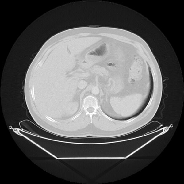 File:Bronchogenic carcinoma with upper lobe collapse (Radiopaedia 29297-29726 Axial lung window 32).jpg