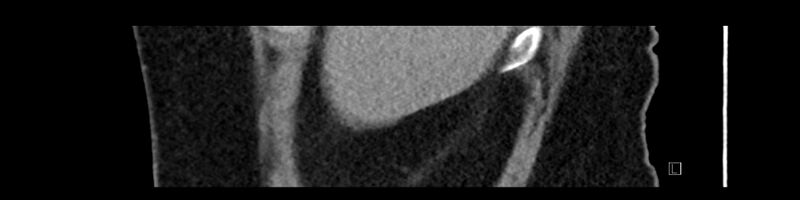 File:Buried bumper syndrome - gastrostomy tube (Radiopaedia 63843-72575 Sagittal Inject 110).jpg