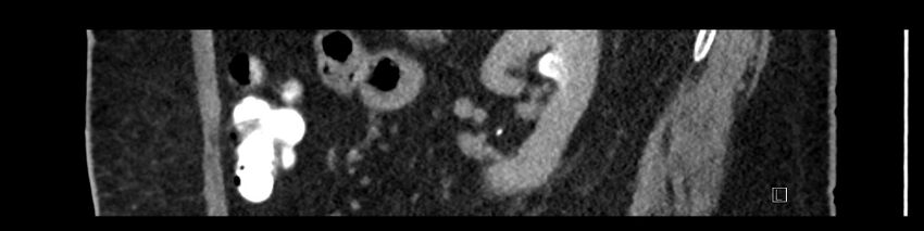 Buried bumper syndrome - gastrostomy tube (Radiopaedia 63843-72575 Sagittal Inject 39).jpg