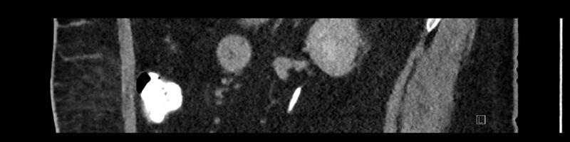 File:Buried bumper syndrome - gastrostomy tube (Radiopaedia 63843-72575 Sagittal Inject 42).jpg