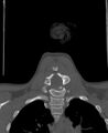 Butterfly vertebra (Radiopaedia 77903-90209 Coronal bone window 50).jpg