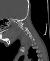 Butterfly vertebra (Radiopaedia 77903-90209 Sagittal bone window 5).jpg