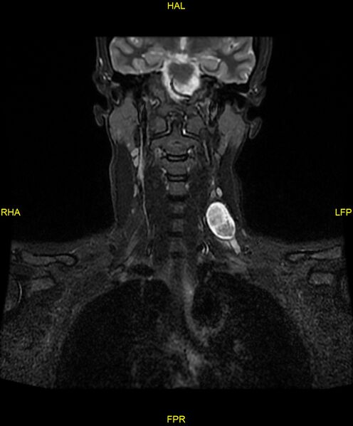 File:C5 nerve sheath tumor (Radiopaedia 85777-101596 Coronal T2 fat sat 9).jpg