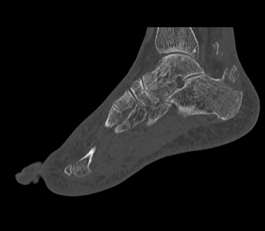 Calcaneal tuberosity avulsion fracture (Radiopaedia 22649-22668 Sagittal bone window 26).jpg