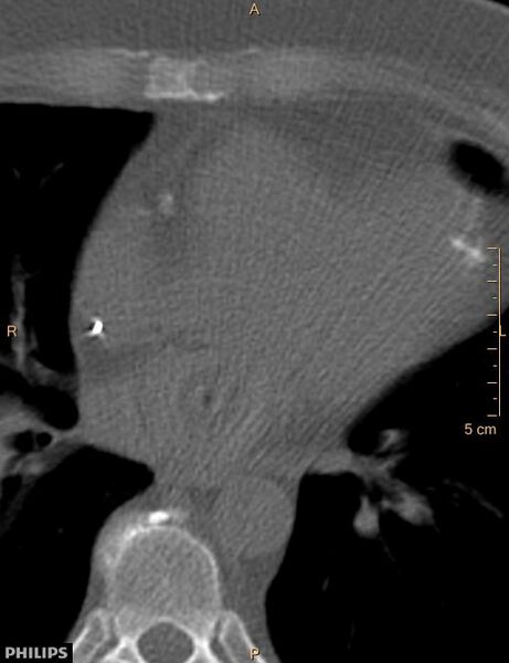 File:Calcified cardiac fibroma (Radiopaedia 39267-41519 Axial bone window 12).jpg