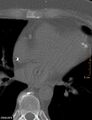 Calcified cardiac fibroma (Radiopaedia 39267-41519 Axial bone window 12).jpg